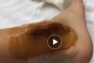 王宝强做手术取出脚中钢板 留下5寸伤疤触目惊心